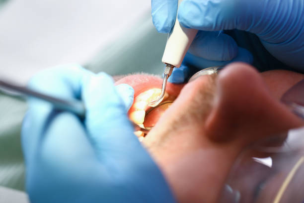 Best Dentist for Tooth Abscess  in Delavan, IL